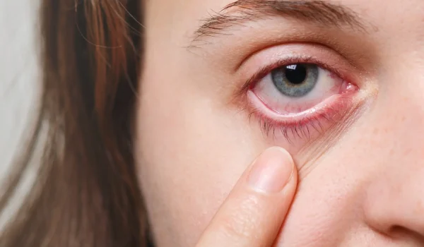 medicine-health-care-eyesight-concept-unrecognizable-female-shows-her-inflated-red-eye-with-blood-capillary